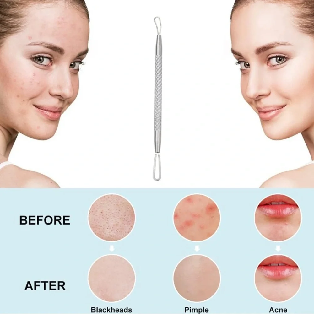 BEAUTÉ SOLINGEN Stainless Steel Blackhead Remover